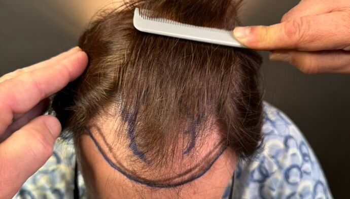 FUT Hair Restoration: Case 49 - Before