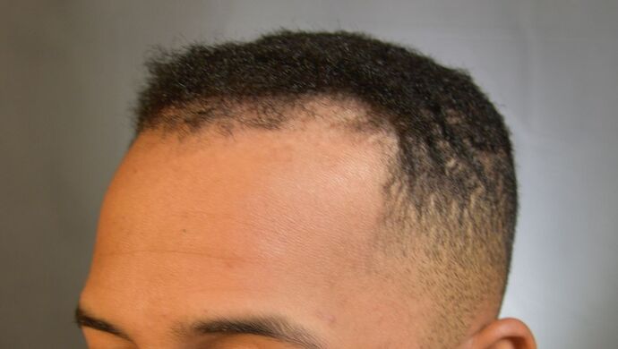FUE Hair Restoration: Case 2 - Before