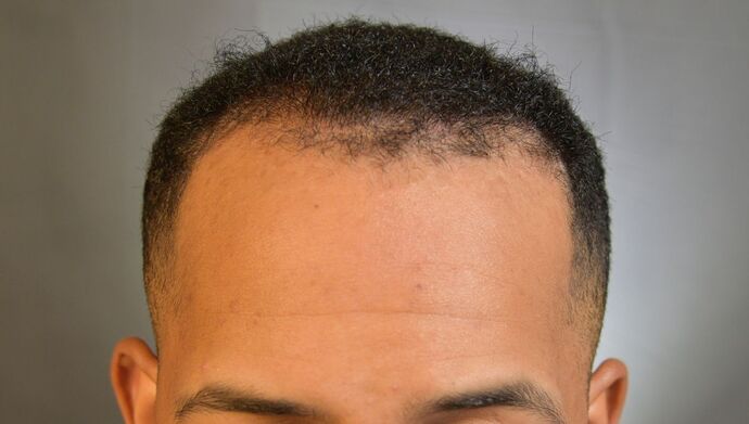 FUE Hair Restoration: Case 2 - Before