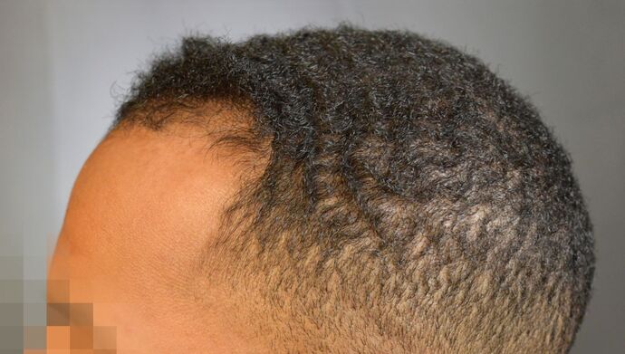 FUE Hair Restoration: Case 2 - Before