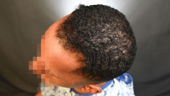FUE Hair Restoration: Case 2 - Before