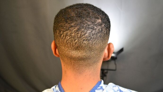 FUE Hair Restoration: Case 2 - Before