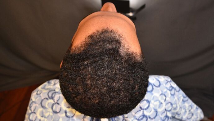 FUE Hair Restoration: Case 2 - Before