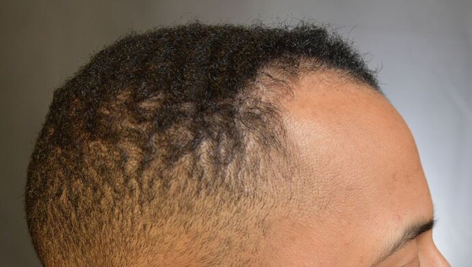 FUE Hair Restoration: Case 2 - Before