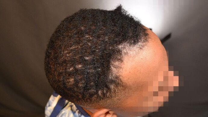 FUE Hair Restoration: Case 2 - Before