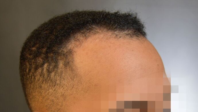 FUE Hair Restoration: Case 2 - Before