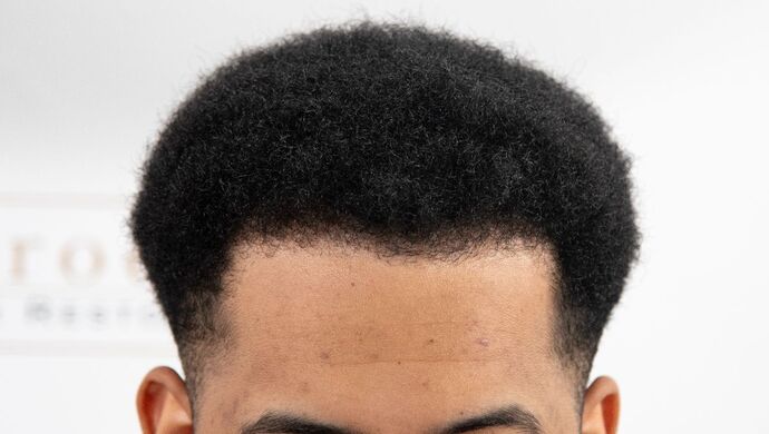 FUE Hair Restoration: Case 2 - After