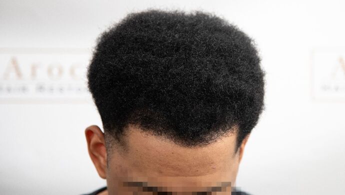 FUE Hair Restoration: Case 2 - After