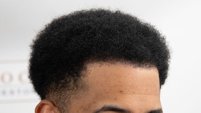 FUE Hair Restoration: Case 2 - After