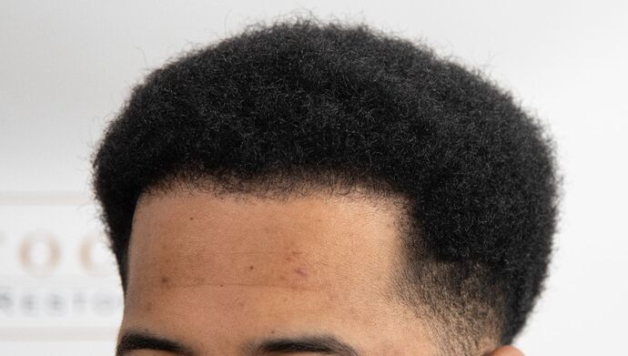 FUE Hair Restoration: Case 2 - After