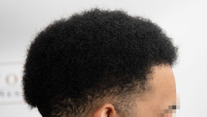 FUE Hair Restoration: Case 2 - After