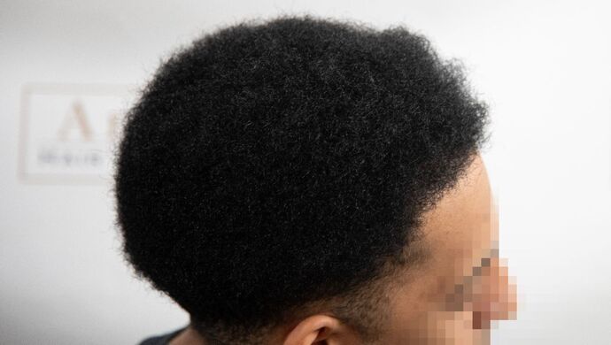 FUE Hair Restoration: Case 2 - After