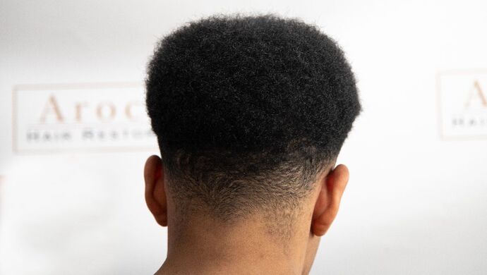 FUE Hair Restoration: Case 2 - After