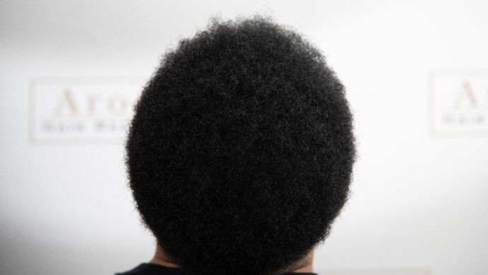 FUE Hair Restoration: Case 2 - After