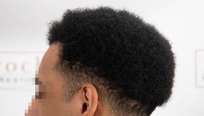 FUE Hair Restoration: Case 2 - After