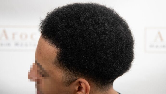 FUE Hair Restoration: Case 2 - After