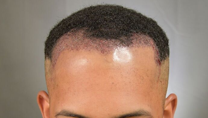 FUE Hair Restoration: Case 2 - Before