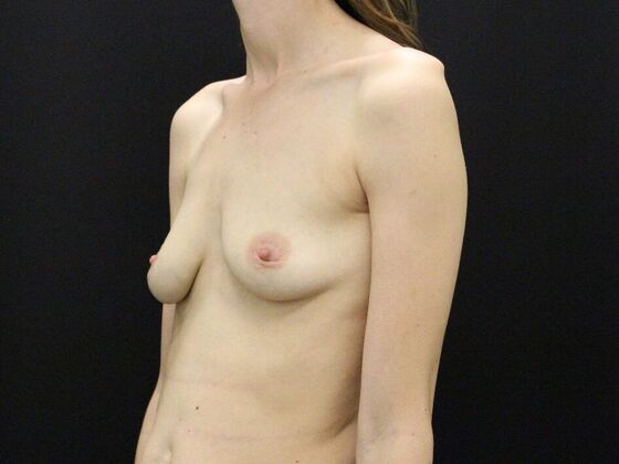 Breast Augmentation: Case 49 - Before