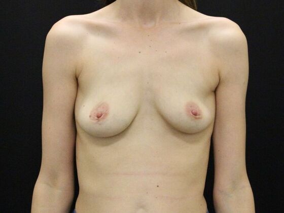 Breast Augmentation Case 49 - Before
