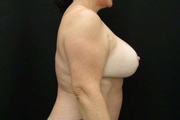 Breast Lift & Breast Lift Augmentation: Case 46 - After