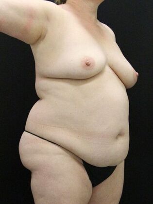 Tummy Tuck: Case 70 - Before