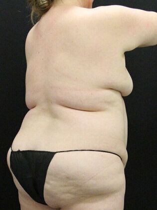 Tummy Tuck: Case 70 - Before