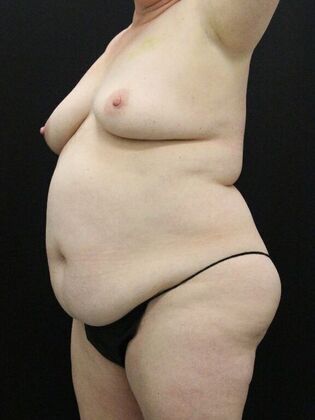 Tummy Tuck: Case 70 - Before