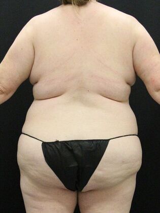 Tummy Tuck: Case 70 - Before