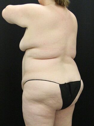 Tummy Tuck: Case 70 - Before