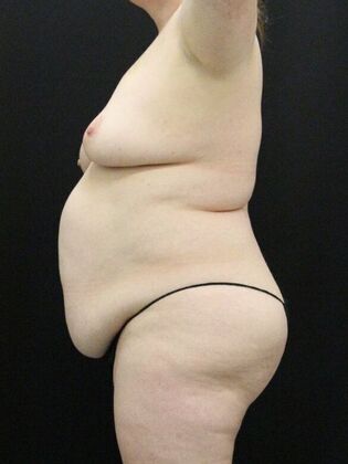 Tummy Tuck: Case 70 - Before