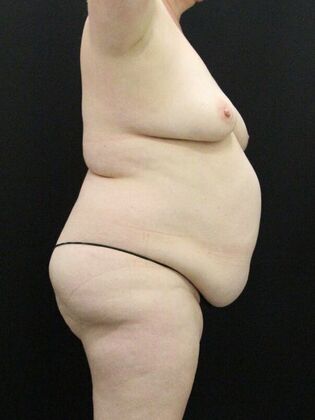 Tummy Tuck: Case 70 - Before