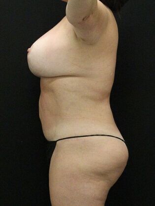 Tummy Tuck: Case 70 - After