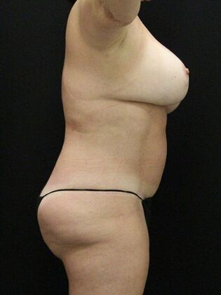 Tummy Tuck: Case 70 - After