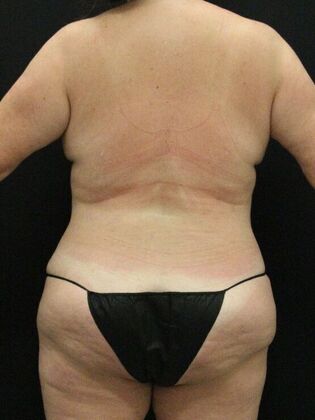 Tummy Tuck: Case 70 - After