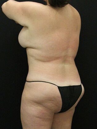 Tummy Tuck: Case 70 - After