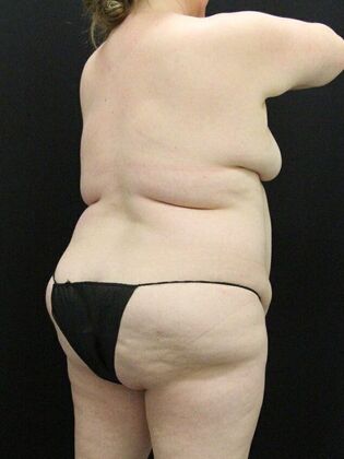 Liposuction: Case 57 - Before