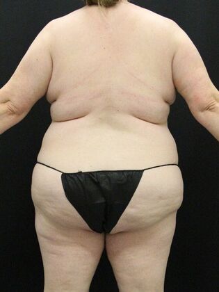 Liposuction Case 57 - Before