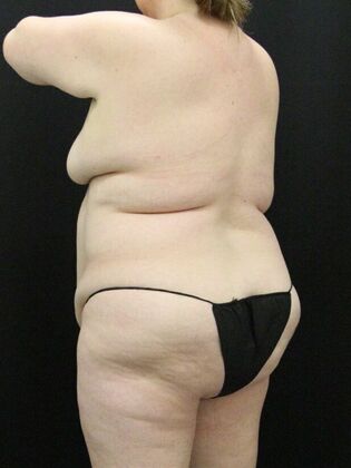 Liposuction: Case 57 - Before