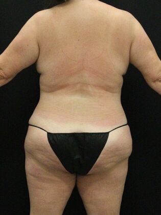 Liposuction Case 57 - After