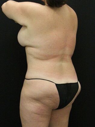 Liposuction: Case 57 - After