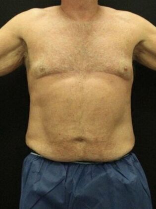 Tummy Tuck Case 81 - Before