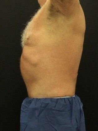 Tummy Tuck: Case 81 - After