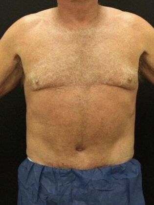 Tummy Tuck Case 81 - After