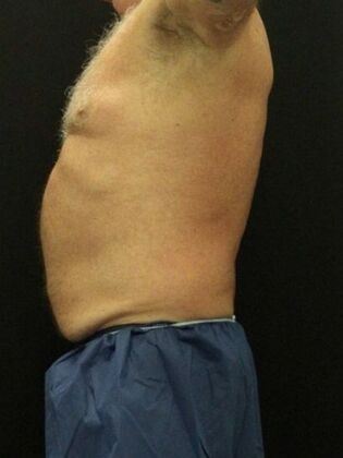 Tummy Tuck: Case 81 - Before