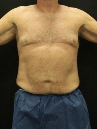Liposuction Case 40 - Before