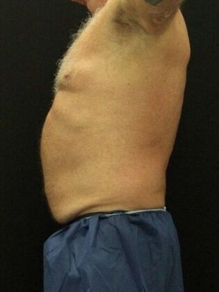 Liposuction: Case 40 - Before