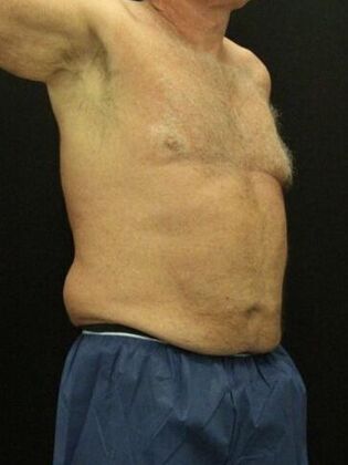 Liposuction: Case 40 - Before