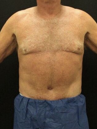 Liposuction Case 40 - After