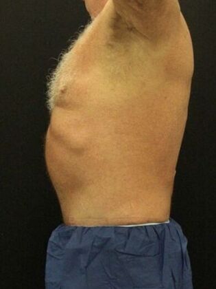 Liposuction: Case 40 - After