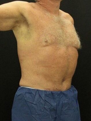 Liposuction: Case 40 - After